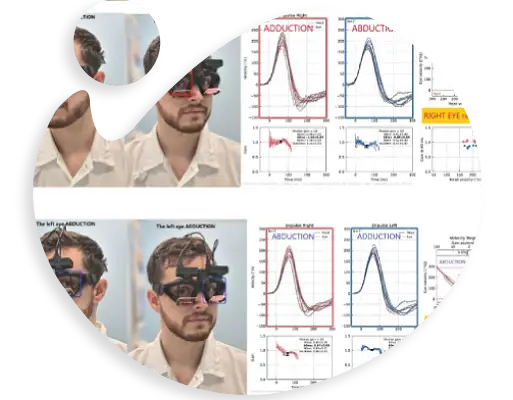 Hyperfunction Vhit Video Head Impulse Test